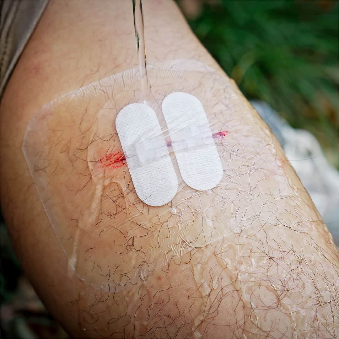 Wound Closure Kit (10-teilig)